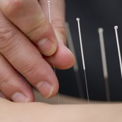 Distal Needle Acupuncture