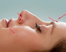 Facial / Cosmetic Acupuncture
